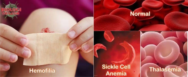 10 Macam Gangguan pada Sistem Peredaran  Darah  Manusia