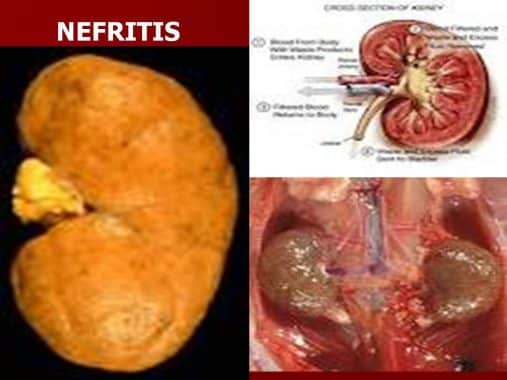 Nefritis adalah gangguan pada sistem ekskresi yang disebabkan oleh